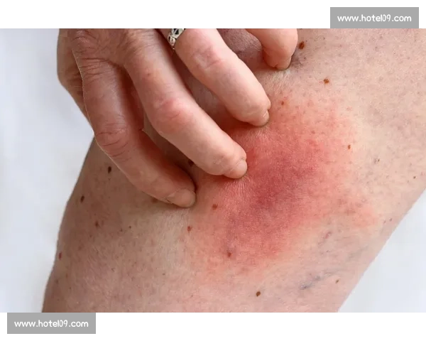 印度亿万富翁马球赛中吞蜂猝死 罕见过敏反应夺命 印度亿万富翁马球赛中吞蜂猝死 罕见过敏反应夺命